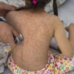 Toluca y Lerma los municipios con casos de sarampión en la región